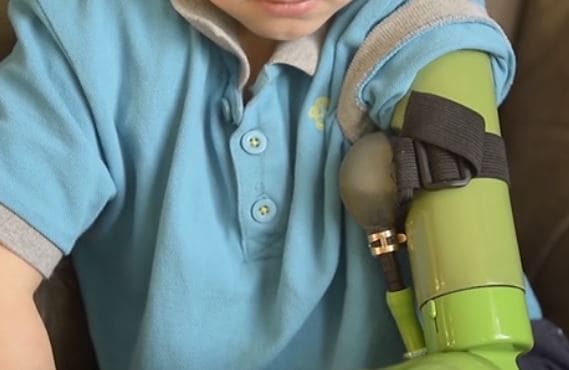 Un joven inglés obtiene un brazo ortopédico robotizado
